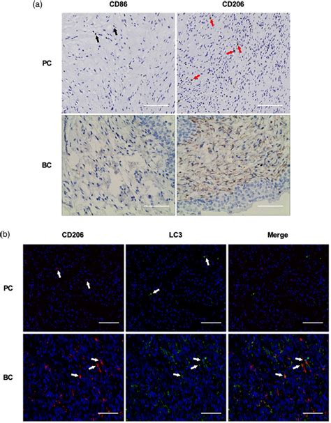 Expression Of M1m2 Macrophage And Autophagy Markers In Bladder Cancer