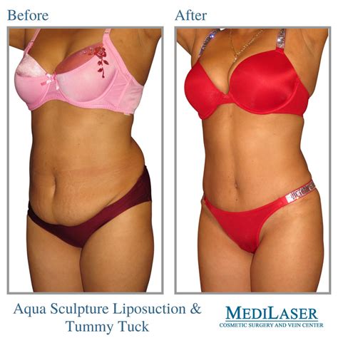 Stomach Liposuction Before And After Women