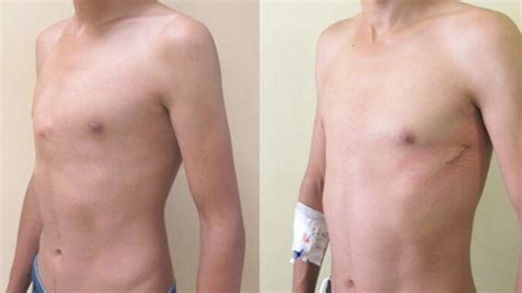 Pioneering Chest Deformity Op Carried Out At Cardiff Hospital