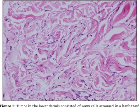 Figure 2 From Neurofibromatosis Type 1 With Beckers Nevus And Nevus Of