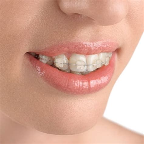 Orthodontics Fairfax Va Braces Invisalign