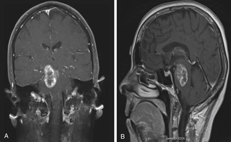 Surgical Management Of Brain Stem Tumors In Adults Neupsy Key