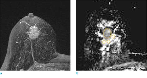 Figure From Prediction Of Axillary Lymph Node Metastasis In Early