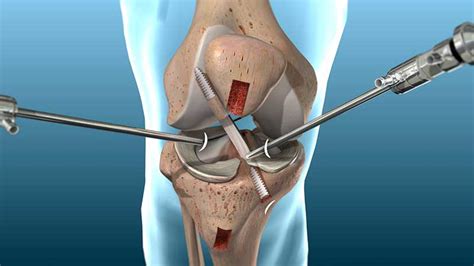 ACL Reconstruction Surgery in Jaipur at affordable cost at jaipurjoints ...