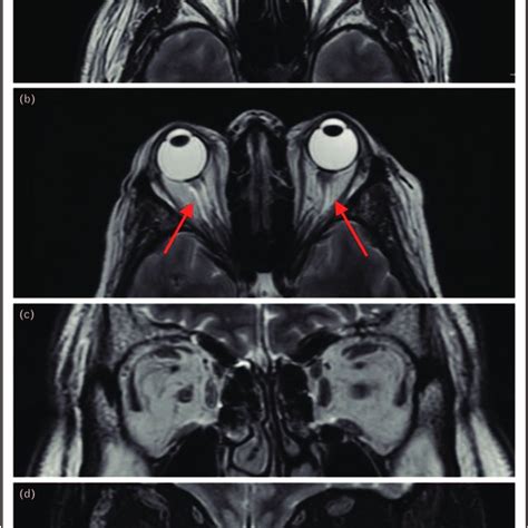 (a) Axial T1-weighted MRI shows normal appearance of the optic nerve... | Download Scientific ...