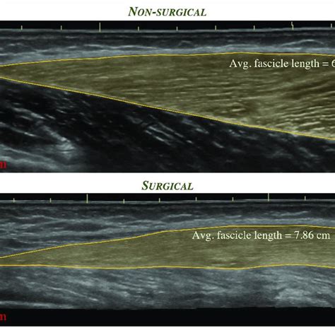 Extended Field Of View Ultrasound Images Depicting The Distal Region