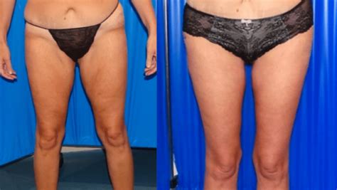 Thigh Lift Procedure Turkey Thighplasty Cost