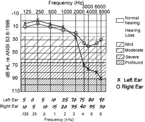 Hearing Loss Frequency Chart Ponasa