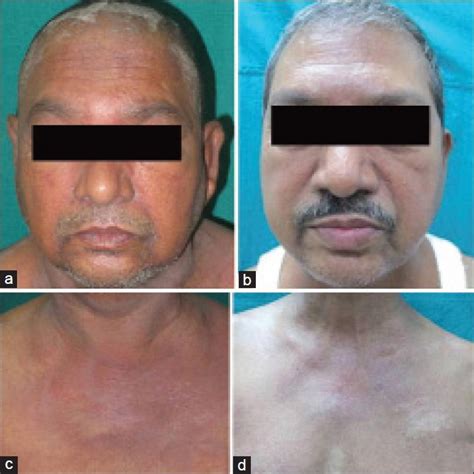 A Cutaneous Examination Of Case 3 Heliotrope Rash And Periorbital