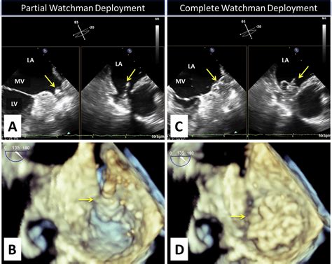 Left Atrial Appendage Occlusion Exclusion Procedural Image Guidance With Transesophageal