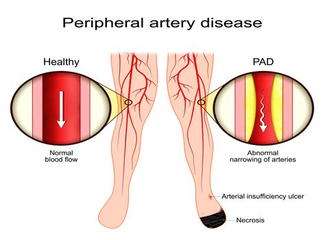 Diabetes Pad Humrahi