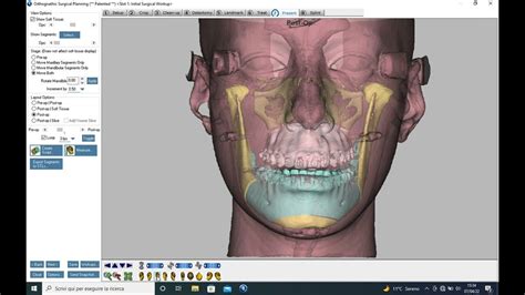 Vsp Virtual Surgical Planning Orthognathic Dolphin Youtube