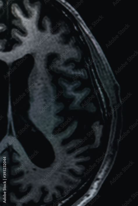 MRI of brain Dementia protocol with Alzheimer's disease Take a picture ...