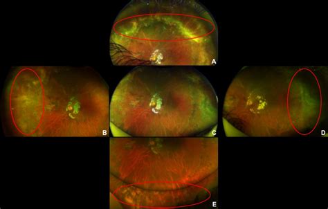 Long Term Follow Up Of Acute Retinal Necrosis With Retinal Detachment