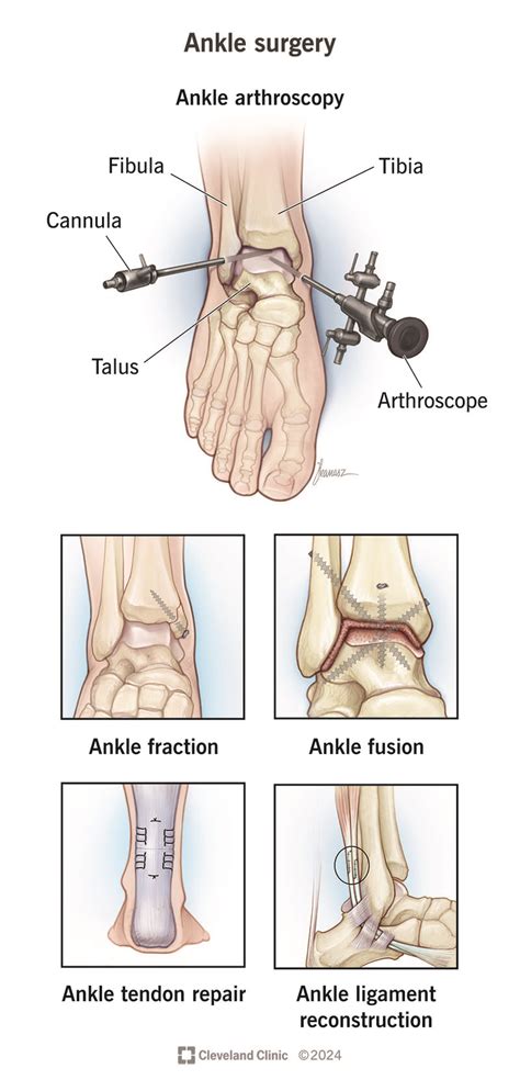 Ankle Surgery: Types, Risks, Pain & Recovery Time