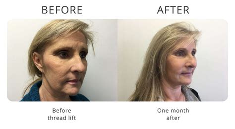 Thread Lift Sydney My Cosmetic Clinic