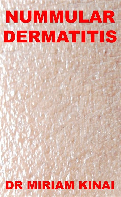 Dermatology Nummular Dermatitis Skin Diseases Book 44 Kindle Edition By Kinai Dr Miriam