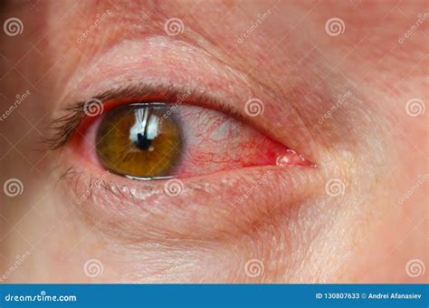 Closeup Irritated Infected Red Bloodshot Eyes Conjunctivitis Stock