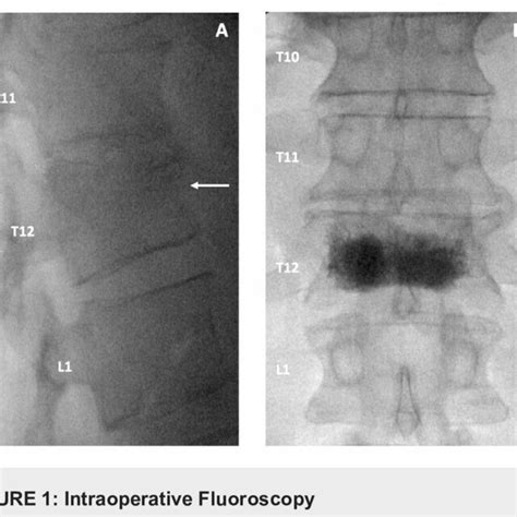 A Lateral Fluoroscopic View Of Thoracolumbar Spine Demonstrating