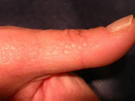 Acrokeratosis Verruciformis Ppt