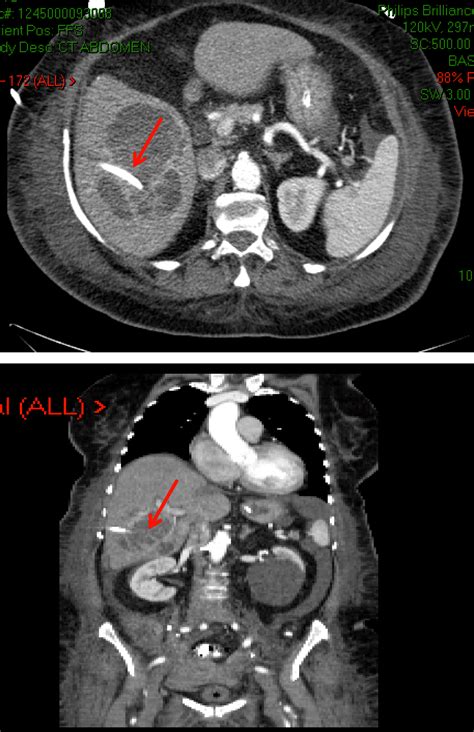 Liver Abscess Drainage