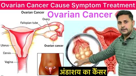 Ovarian Cancer Cause Symptoms Diagnosis Treatment In Hindi What Is Ovarian Cancer Ovarian