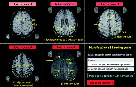 Comparison Of Boston Criteria For Cerebral Amyloid