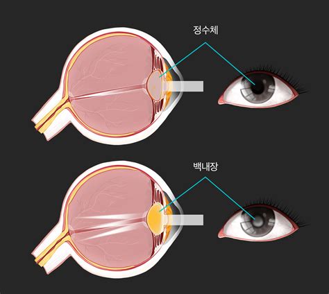 백내장 초기 증상 원인 치료 백내장 수술 후 주의사항 보기 A2