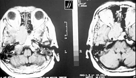 Radioogle Ent Right Sphenoidal Sinus Tumor