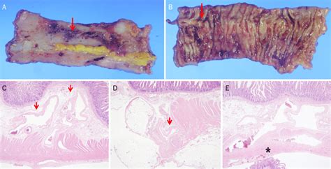 Histopathology Findings A B Gross Findings Of The Resected Ileum