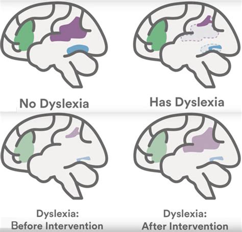 Reading Dyslexia And Brain Plasticity High Performance Learning