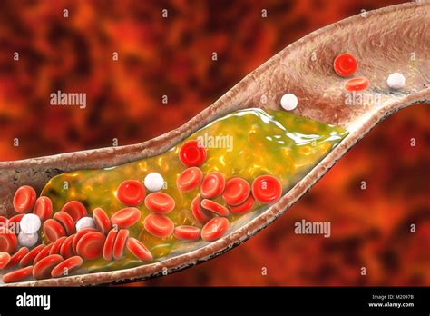 Placche Ateromatose All Interno Del Vaso Sanguigno Illustrazione Del