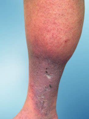 Effective Venous Insufficiency Treatment Tampa Expert Vascular Care