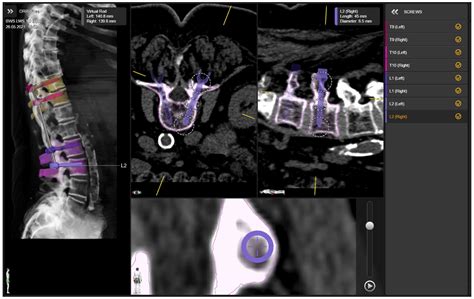 Jcm Free Full Text Initial Intraoperative Experience With Robotic