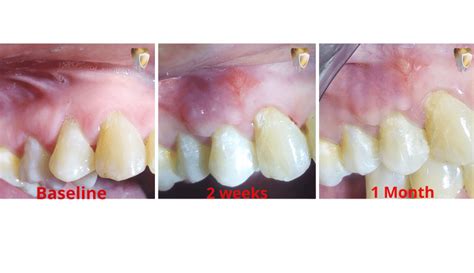 Management Of Single Miller Class I Gingival Recession Through