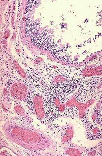 Acute And Chronic Inflammation Flashcards Quizlet