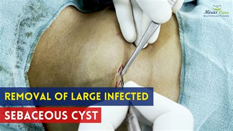 Removal Of Large Infected Sebaceous Cyst Sebaceous Cyst Treatment In Delhi Ncr Youtube