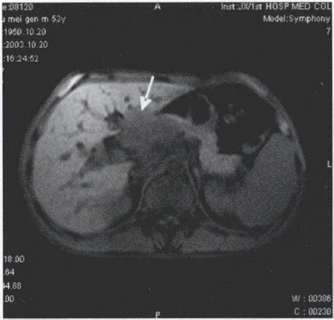 胆管癌 临床医学 医学