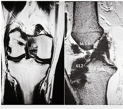 Figure 2 From Double Versus Single Bundle Anterior Cruciate Ligament