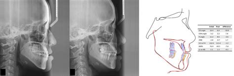 A Typical Case Of Class III Malocclusion Treatment Using Total