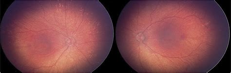 PERIPHERAL RETINAL DRUSEN–LIKE DEPOSITS IN GUCY2C CONGENITAL... : Retinal Cases and Brief Reports