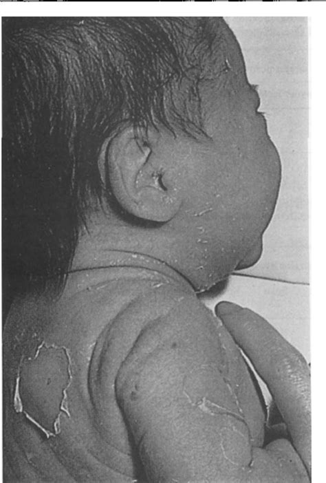 Figure 1 From Staphylococcal Scalded Skin Syndrome Semantic Scholar