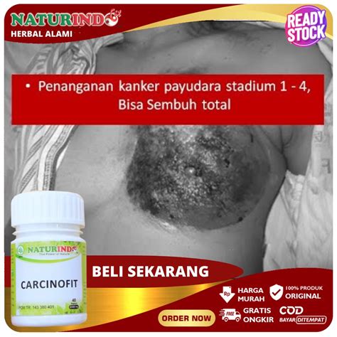 Jual Obat Kanker Payudara Paling Ampuh Tumor Payudara Benjolan Di