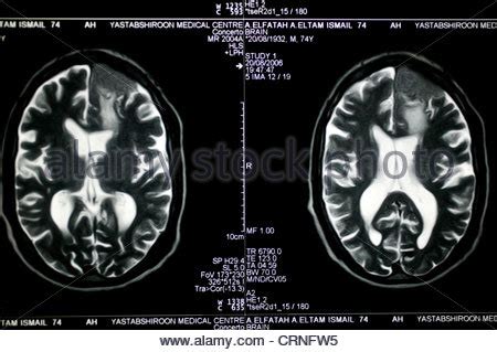 Mri Scans Of A Patient S Brain Stock Photo Alamy