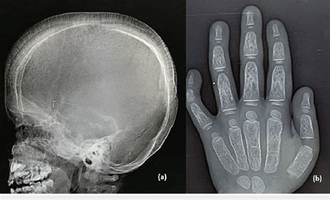 Lateral Skull Radiograph A Showing Widened Diploic Space With