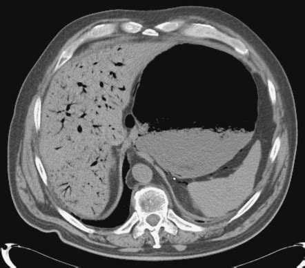 Portal Venous Gas Radiology Reference Article Radiopaedia Org