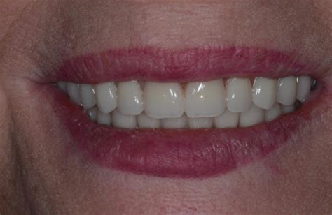 Full Mouth Implant Dentist Dental Implants And Teeth Implants