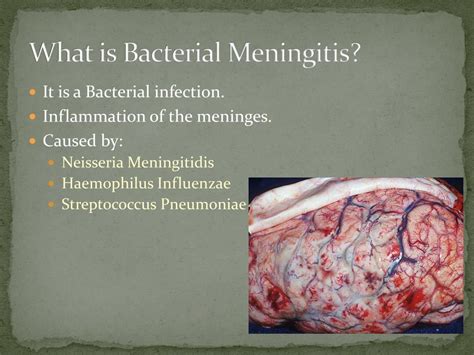 Ppt Bacterial Meningitis Powerpoint Presentation Free Download Id2686420