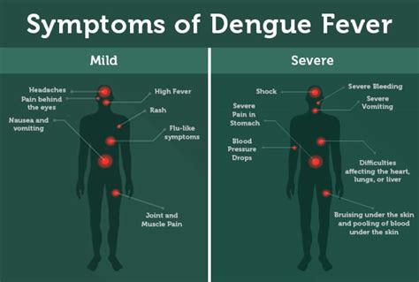 dengue-symptoms-article-2 – Dengue PCR