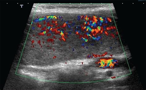 Graves Disease Thyroid Ultrasound
